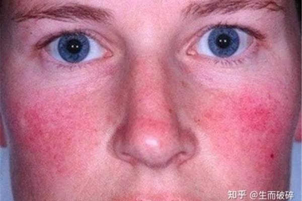 什么是玫瑰痘痘,面部玫瑰痘痘最好的治疗方法?